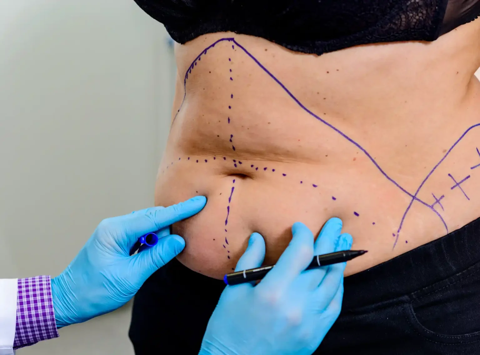 Beyond the Scale: The Real Role of Liposuction in Modern Body Contouring